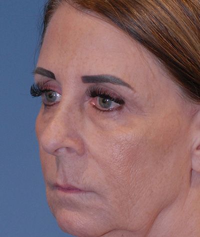 Rhinoplasty Before & After