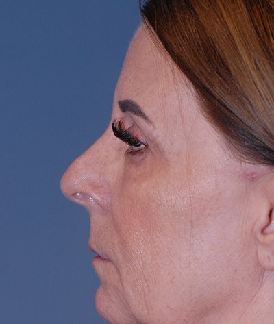 Rhinoplasty Before & After