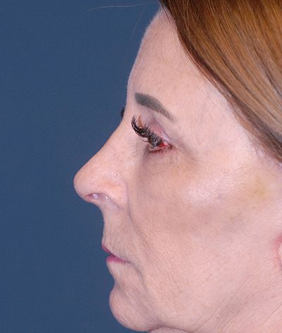 Rhinoplasty Before & After