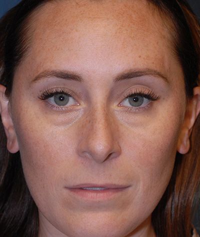 Rhinoplasty Before & After