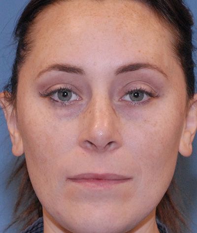 Rhinoplasty Before & After