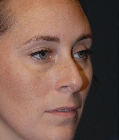 Rhinoplasty Before & After