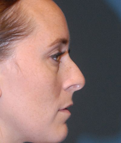 Rhinoplasty Before & After