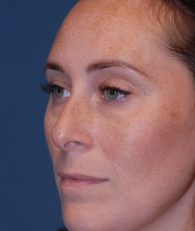 Rhinoplasty Before & After