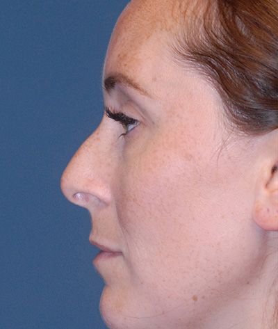 Rhinoplasty Before & After