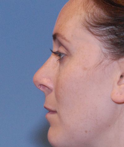 Rhinoplasty Before & After