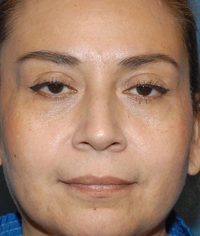 Rhinoplasty Before & After