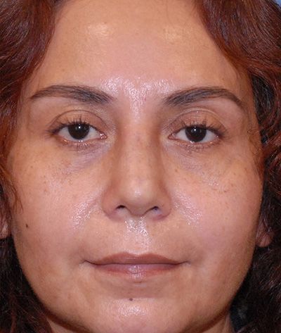 Rhinoplasty Before & After