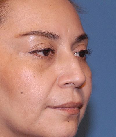 Rhinoplasty Before & After