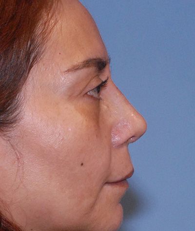 Rhinoplasty Before & After