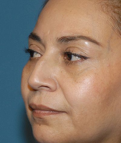 Rhinoplasty Before & After