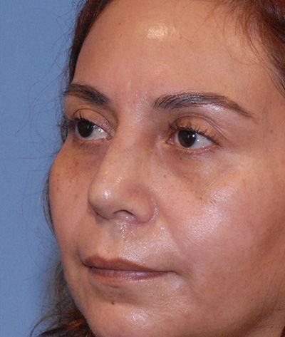 Rhinoplasty Before & After