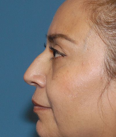 Rhinoplasty Before & After