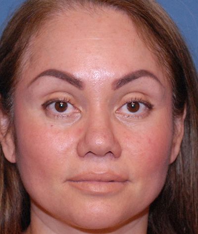 Rhinoplasty Before & After