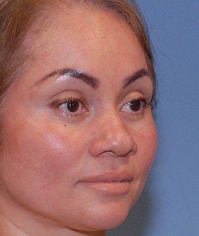 Rhinoplasty Before & After