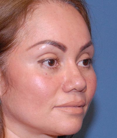 Rhinoplasty Before & After