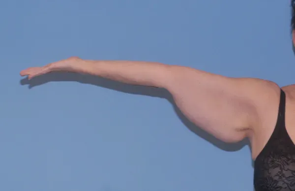Arm Lift Before & After