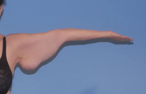 Arm Lift Before & After
