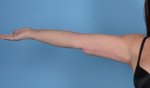 Arm Lift Before & After