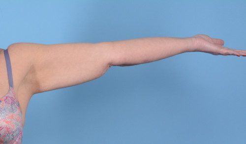 Arm Lift Before & After