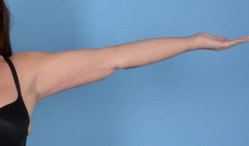 Arm Lift Before & After