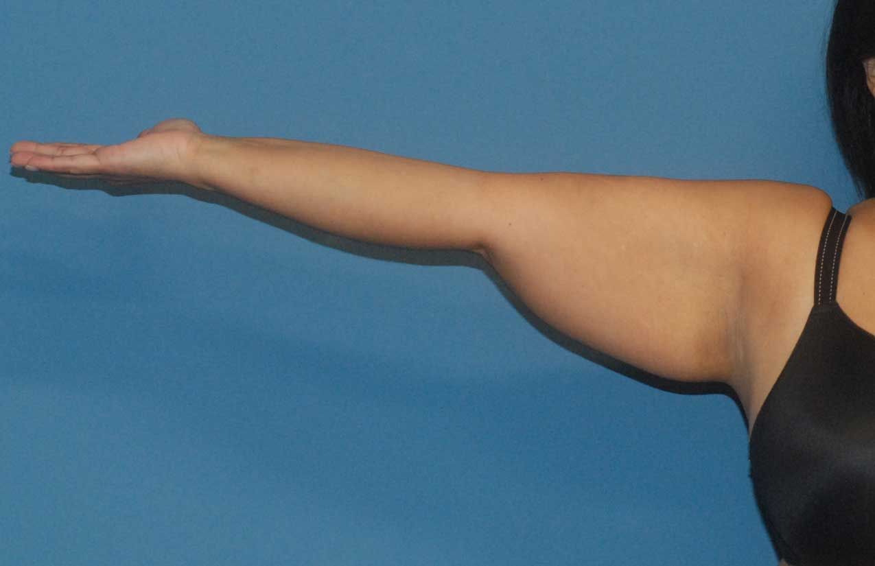 Arm Lift Before & After