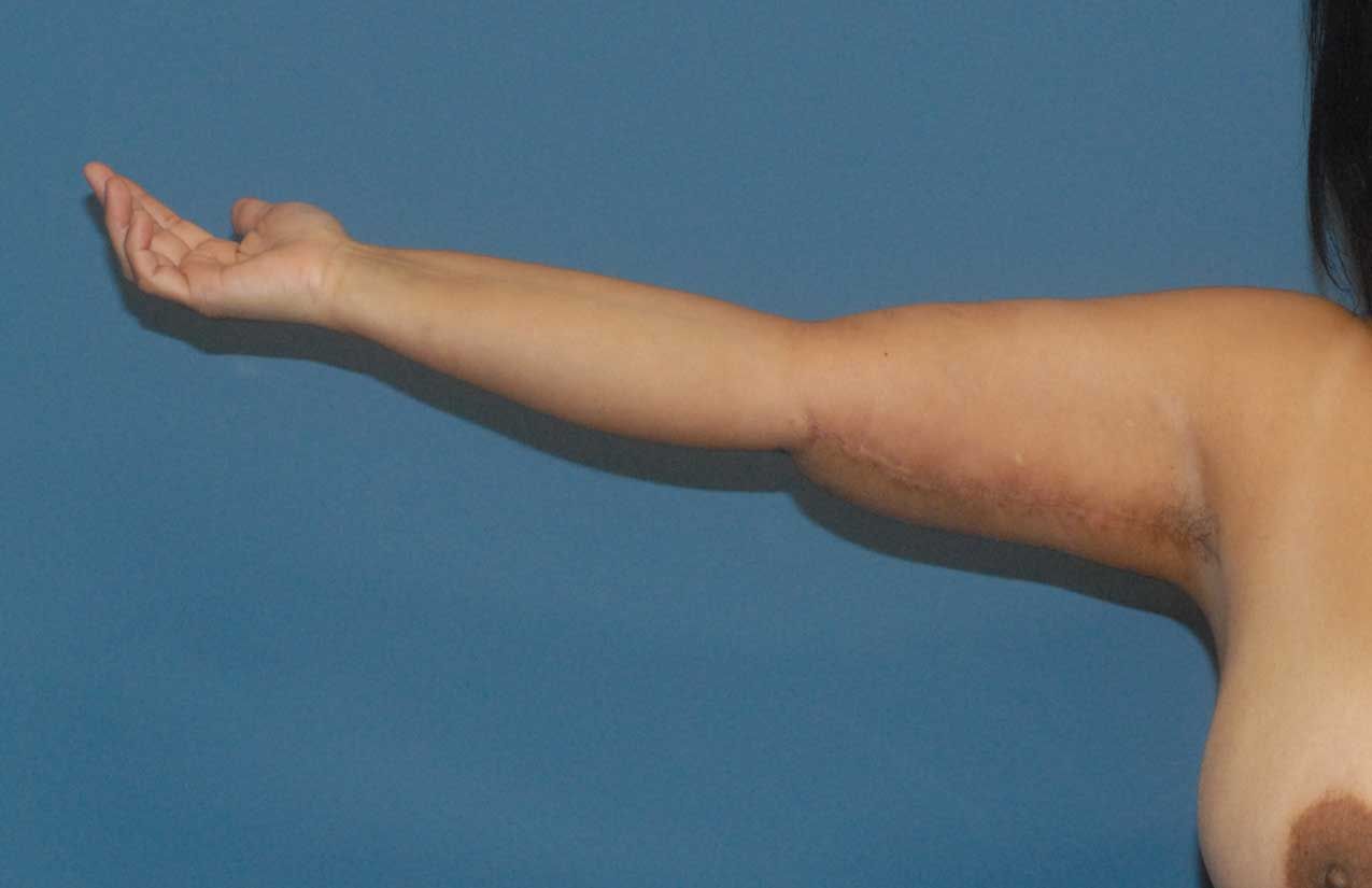 Arm Lift Before & After