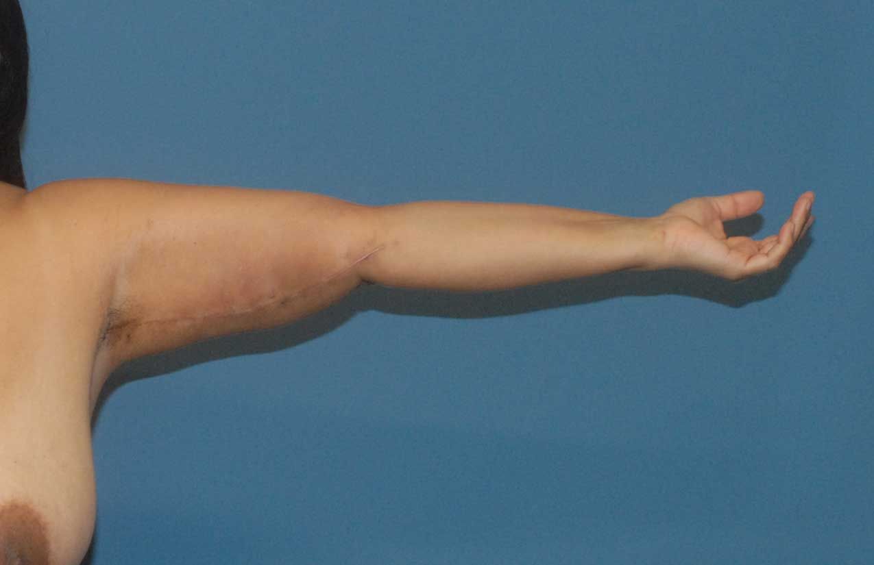 Arm Lift Before & After