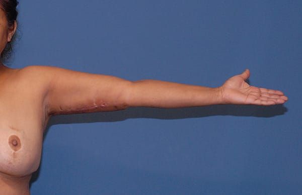 Arm Lift Before & After