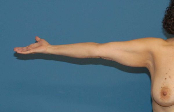 Arm Lift Before & After