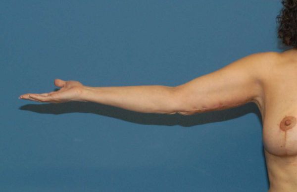 Arm Lift Before & After