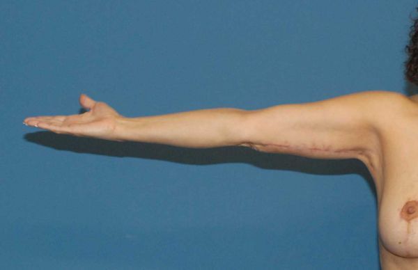 Arm Lift Before & After