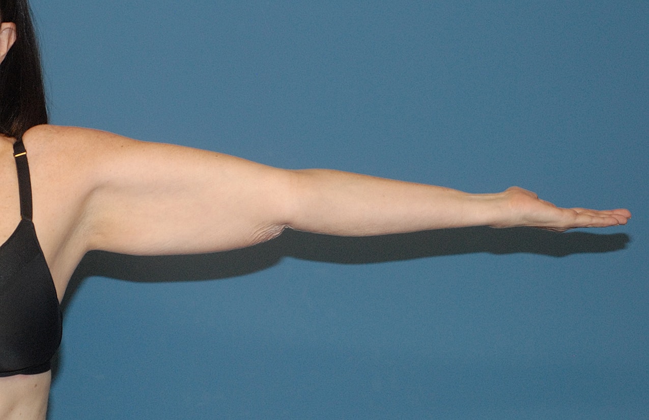 Arm Lift Before & After