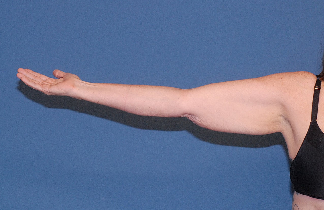 Arm Lift Before & After