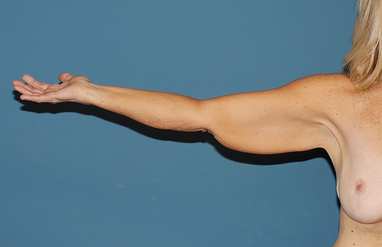 Arm Lift Before & After
