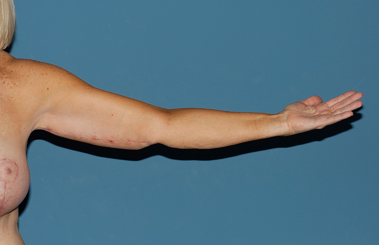 Arm Lift Before & After