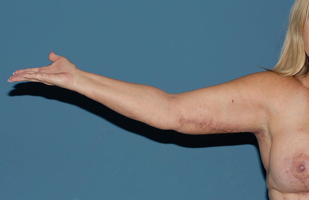 Arm Lift Before & After