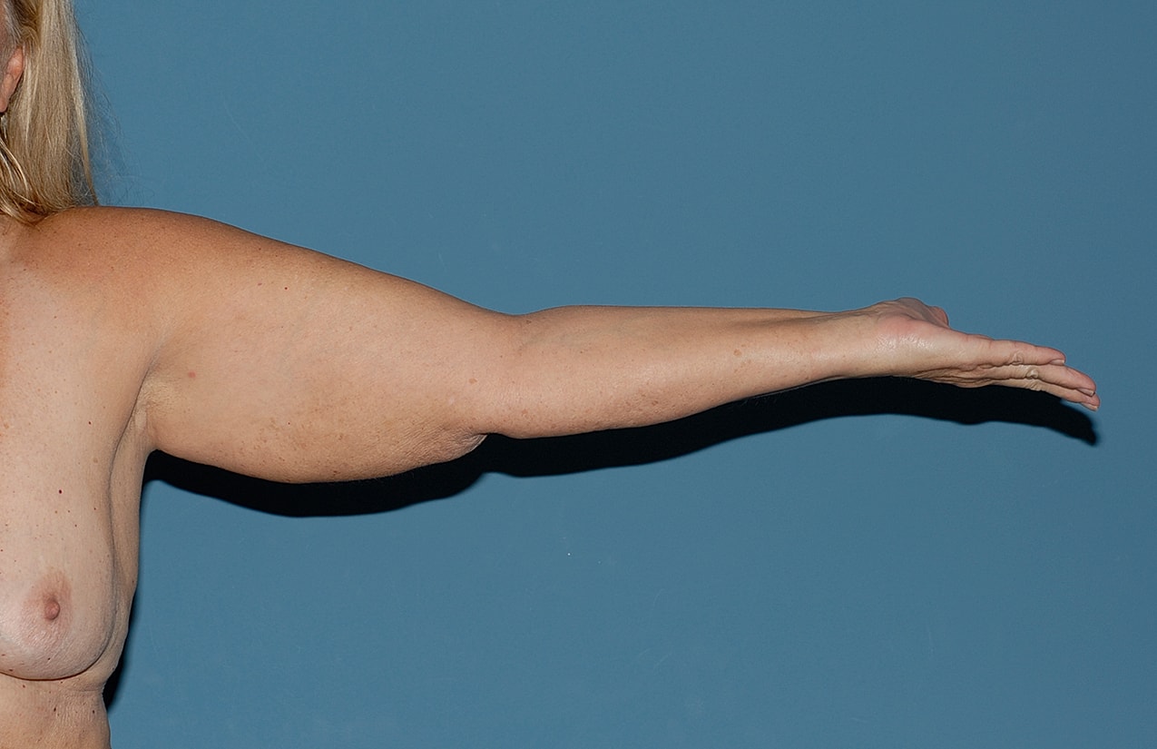 Arm Lift Before & After