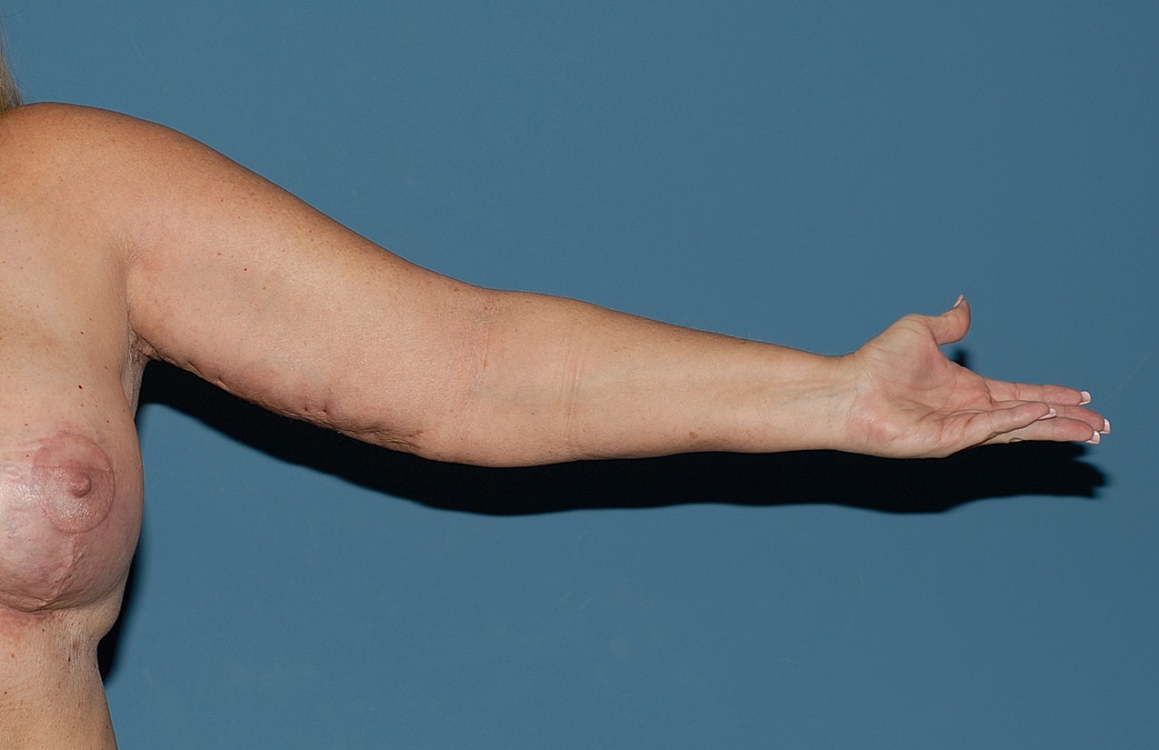 Arm Lift Before & After