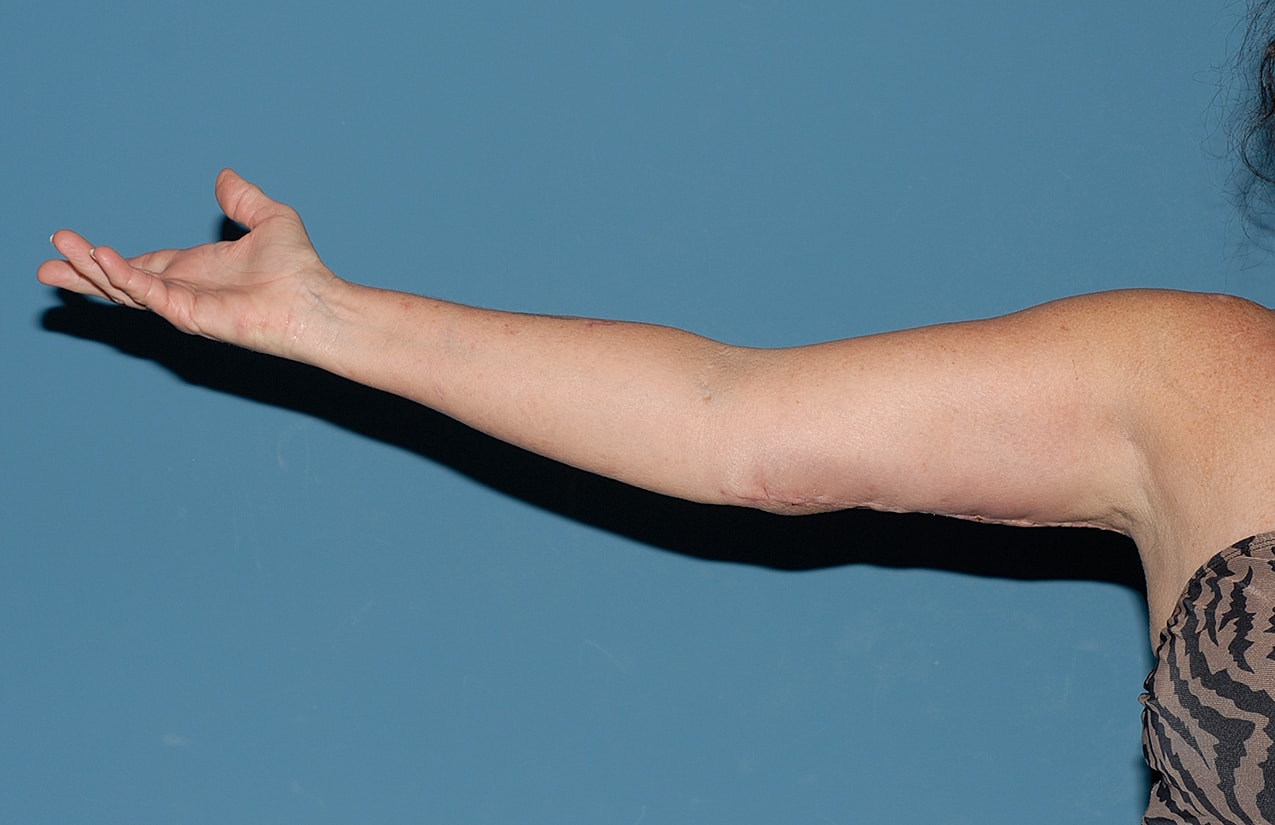 Arm Lift Before & After