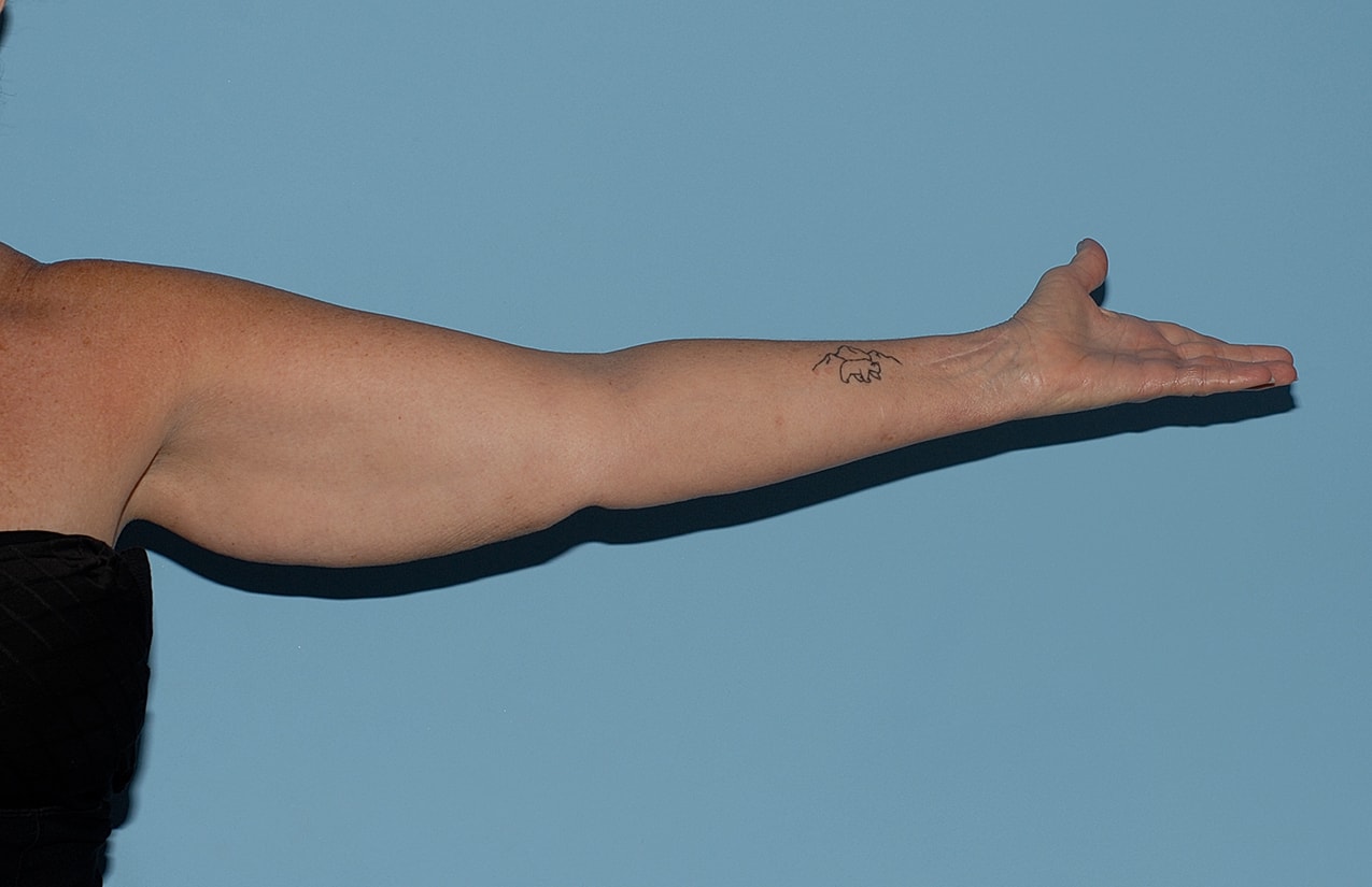 Arm Lift Before & After