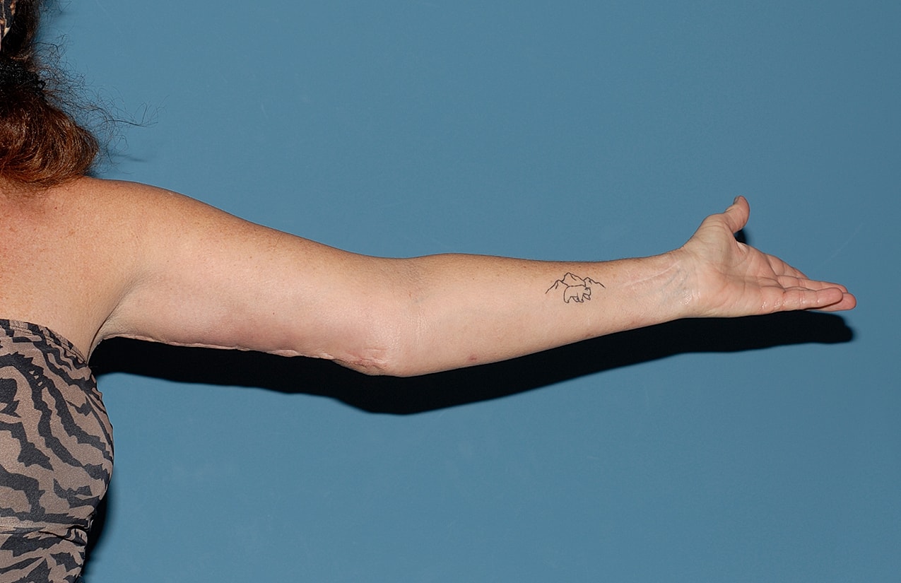 Arm Lift Before & After