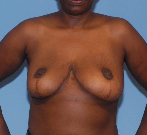 Breast Corrections And Revisions Before & After
