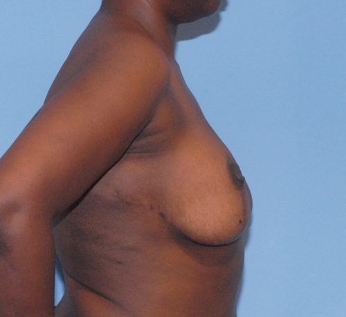 Breast Corrections And Revisions Before & After