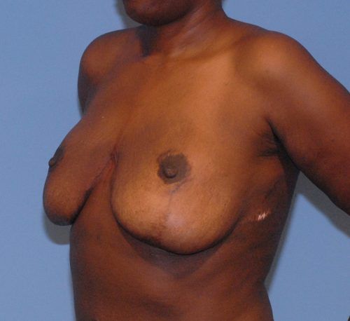 Breast Corrections And Revisions Before & After