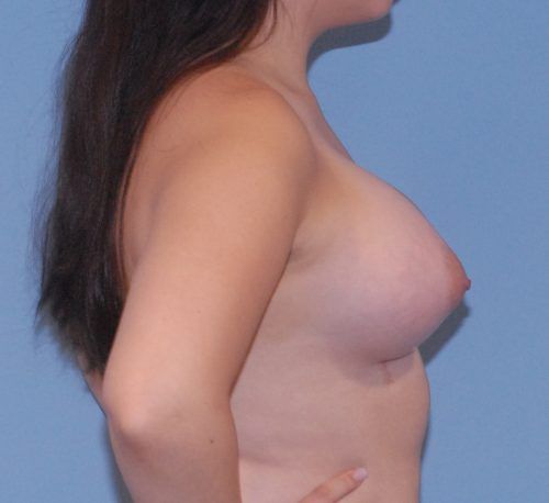 Breast Corrections And Revisions Before & After
