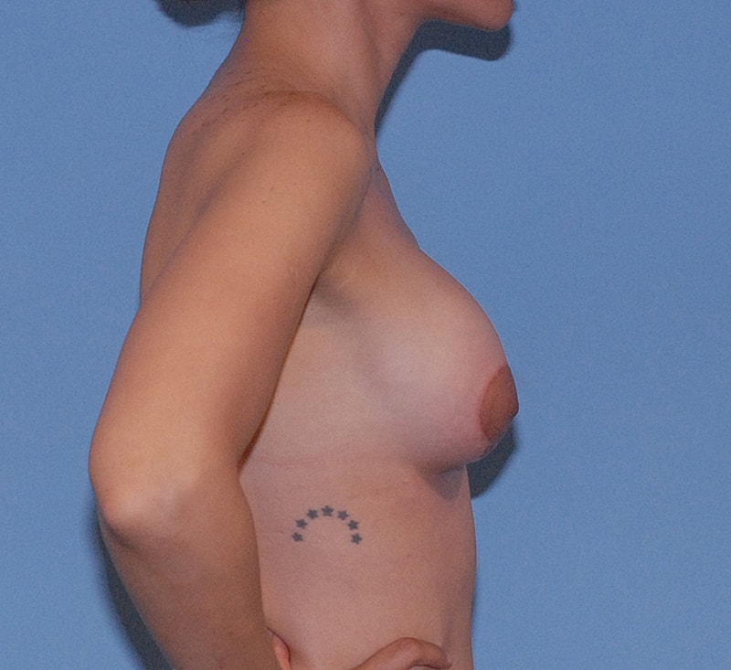 Breast Corrections And Revisions Before & After