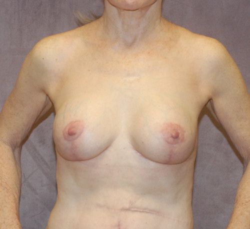 Breast Corrections And Revisions Before & After