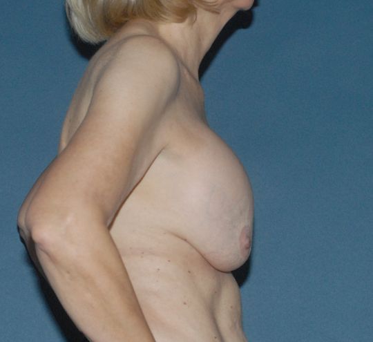 Breast Corrections And Revisions Before & After