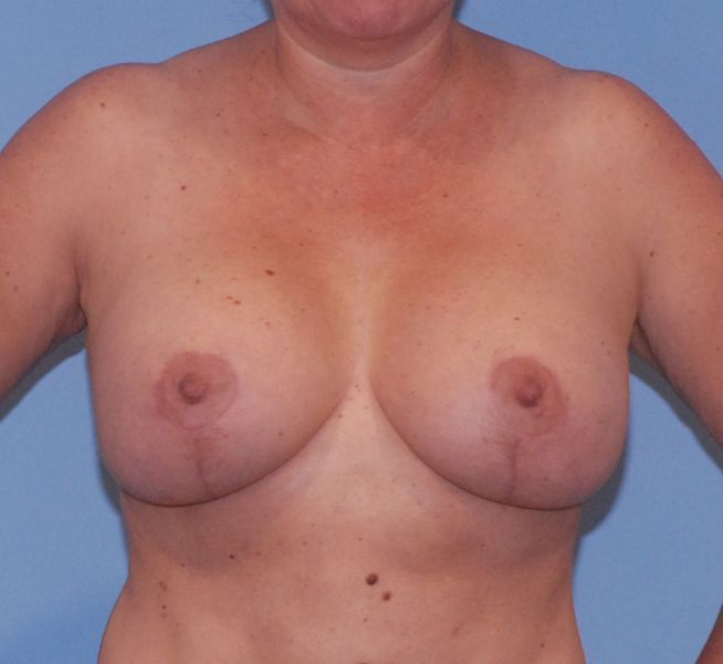 Breast Corrections And Revisions Before & After